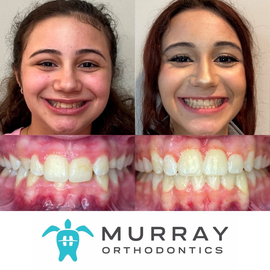 A teen patient's smile and teeth before and after orthodontic treatment at Murray Orthodontics